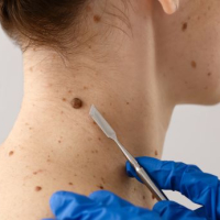 How Common is Skin Cancer? A Breakdown by Age, Gender, and Skin Type